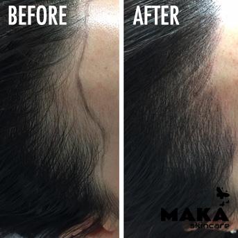 Female Hairline Microblading